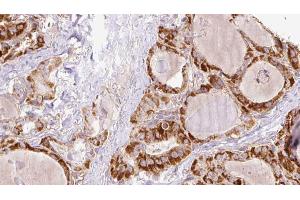 ABIN6267199 at 1/100 staining Human thyroid cancer tissue by IHC-P. (TNK1 anticorps  (pTyr277))