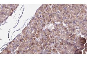 ABIN6273264 at 1/100 staining Human pancreas cancer tissue by IHC-P.