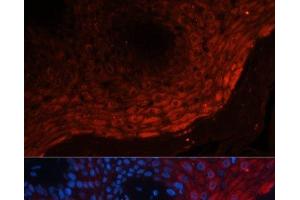 Immunofluorescence analysis of Human skin cancer using S100A8 Polyclonal Antibody at dilution of 1:100 (40x lens). (S100A8 anticorps)