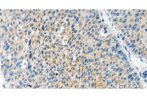 Immunohistochemistry of paraffin-embedded Human liver cancer using TPM2 Polyclonal Antibody at dilution of 1:60 (TPM2 anticorps)