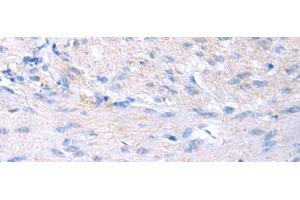 Immunohistochemistry of paraffin-embedded Human gastric cancer tissue using PROC Polyclonal Antibody at dilution of 1:80(x200) (PROC anticorps)