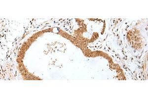 Immunohistochemistry of paraffin-embedded Human gastric cancer tissue using PEG3 Polyclonal Antibody at dilution of 1:45(x200) (PEG3 anticorps)