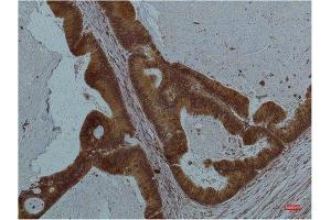 Immunohistochemistry (IHC) analysis of paraffin-embedded Human Colon Carcicnoma using STAT3 Mouse Monoclonal Antibody diluted at 1:200. (STAT3 anticorps)