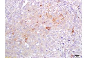 Formalin-fixed and paraffin embedded human lung carcinoma labeled with Rabbit Anti CRP Polyclonal Antibody, Unconjugated (ABIN725570) at 1:200 followed by conjugation to the secondary antibody and DAB staining (CRP anticorps  (AA 125-224))