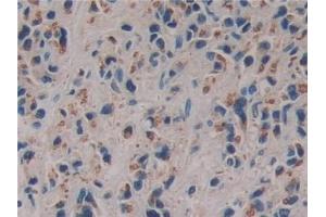 Detection of FAM3C in Human Prostate cancer Tissue using Polyclonal Antibody to Family With Sequence Similarity 3, Member C (FAM3C) (FAM3C anticorps  (AA 25-227))