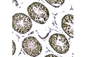 IHC testing of FFPE human breast cancer tissue with UBA2 antibody at 1ug/ml. (UBA2 anticorps)