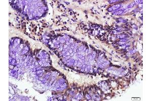 Paraformaldehyde-fixed, paraffin embedded human colon cancer, Antigen retrieval by boiling in sodium citrate buffer (pH6. (ATG16L1 anticorps  (AA 501-607))