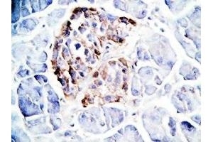 Human pancreas cancer tissue was stained by Rabbit Anti-GLP-1(7-36) -NH2 Antibody (GLP-1 anticorps  (amidated))