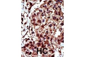 Formalin-fixed and paraffin-embedded human cancer tissue reacted with the primary antibody, which was peroxidase-conjugated to the secondary antibody, followed by AEC staining. (DGKI anticorps  (C-Term))