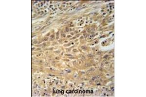 CNNM4 Antibody (Center) (ABIN651611 and ABIN2840324) immunohistochemistry analysis in formalin fixed and paraffin embedded human lung carcinoma followed by peroxidase conjugation of the secondary antibody and DAB staining. (CNNM4 anticorps  (AA 565-593))