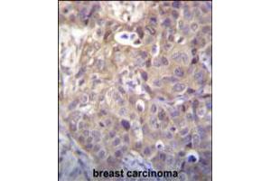 HIPK1 Antibody immunohistochemistry analysis in formalin fixed and paraffin embedded human breast carcinoma followed by peroxidase conjugation of the secondary antibody and DAB staining.