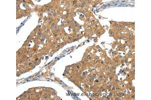 Immunohistochemistry of Human ovarian cancer using SCN5A Polyclonal Antibody at dilution of 1:30 (SCN5A anticorps)