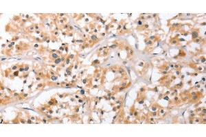 Immunohistochemistry of paraffin-embedded Human thyroid cancer using HDAC8 Polyclonal Antibody at dilution of 1:40