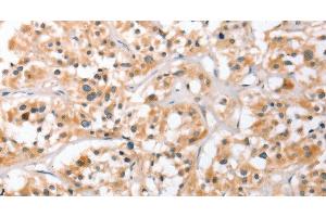 Immunohistochemistry of paraffin-embedded Human thyroid cancer using HDAC8 Polyclonal Antibody at dilution of 1:40 (HDAC8 anticorps)