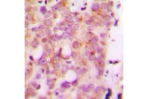 Immunohistochemical analysis of HLA-H staining in human breast cancer formalin fixed paraffin embedded tissue section.