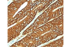 IHC testing of colon carcinoma stained with EpCAM antibody (VU-1D9). (EpCAM anticorps)