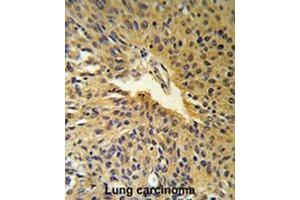 COG2 Antibody (N-term) IHC analysis in formalin fixed and paraffin embedded human Lung carcinoma followed by peroxidase conjugation of the secondary antibody and DAB staining.