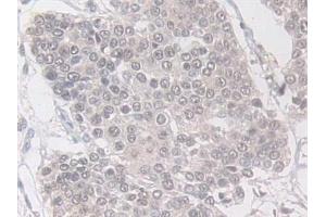 Detection of VAPB in Human Pancreatic cancer Tissue using Polyclonal Antibody to Vesicle Associated Membrane Protein Associated Protein B (VAPB)