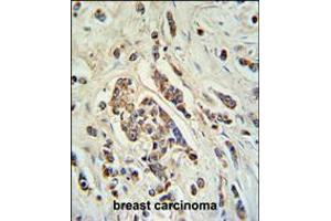 ABCC11 Antibody IHC analysis in formalin fixed and paraffin embedded breast carcinoma followed by peroxidase conjugation of the secondary antibody and DAB staining.