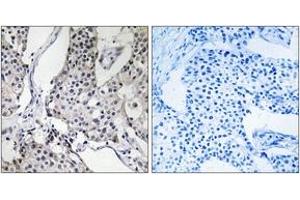 Immunohistochemistry analysis of paraffin-embedded human breast carcinoma tissue, using PHLDA3 Antibody. (PHLDA3 anticorps  (AA 21-70))