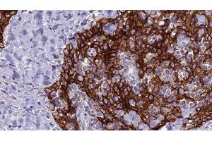 ABIN6279128 at 1/100 staining Human Head and neck cancer tissue by IHC-P. (SLC4A9 anticorps)