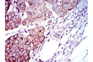Immunohistochemical analysis of paraffin-embedded breast cancer tissues using RPS6KB1 mouse mAb with DAB staining.