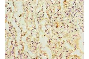 Immunohistochemistry of paraffin-embedded human lung cancer using ABIN7172386 at dilution of 1:100 (L3HYPDH anticorps  (AA 13-312))