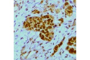 Expression of HuR in a breast tumor (FFPE section)  by staining with 19F12 monoclonal antibody