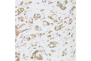 Immunohistochemistry of paraffin-embedded human gastric cancer using DMAP1 antibody.