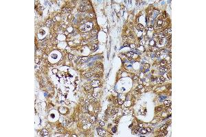 Immunohistochemistry of paraffin-embedded human colon carcinoma using MAK antibody (ABIN7268382) at dilution of 1:100 (40x lens).