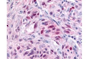 Anti-NR1D2 antibody IHC of human Skin, Melanoma.