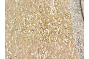 ABIN6265012 and ABIN6276810 at 1/100 staining human hepatocellular carcinoma by IHC-P.