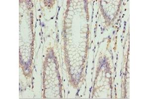 Immunohistochemistry of paraffin-embedded human colon cancer using ABIN7151997 at dilution of 1:100