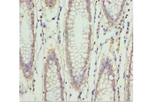 Immunohistochemistry of paraffin-embedded human colon cancer using ABIN7151997 at dilution of 1:100 (ERLIN2 anticorps  (AA 212-339))