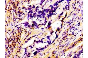 Immunohistochemistry of paraffin-embedded human pancreatic cancer using ABIN7167322 at dilution of 1:100 (RAB3A anticorps  (AA 1-220))