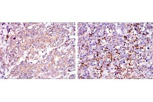 Immunohistochemical analysis of paraffin-embedded stomach cancer tissues (left) and brain tumor (right) using SMN1 mouse mAb with DAB staining.