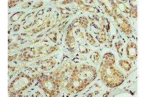 Immunohistochemistry of paraffin-embedded human breast cancer using ABIN7159904 at dilution of 1:100