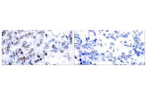 Immunohistochemical analysis of paraffin-embedded human breast carcinoma tissue using JunB (Ab-79) antibody(E021026). (JunB anticorps)