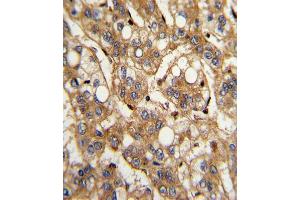Formalin-fixed and paraffin-embedded human hepatocarcinoma with IFNB1 Antibody (N-term), which was peroxidase-conjugated to the secondary antibody, followed by DAB staining.