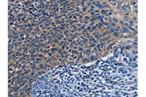 The image on the left is immunohistochemistry of paraffin-embedded Human cervical cancer tissue using ABIN7130029(KLRB1 Antibody) at dilution 1/40, on the right is treated with fusion protein.