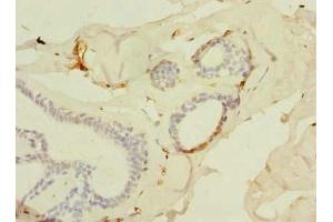 Immunohistochemistry of paraffin-embedded human breast cancer using ABIN7143534 at dilution of 1:100
