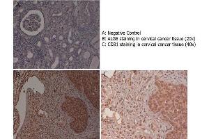 Immunohistochemistry with anti-ALG6 antibody showing ALG6 staining in the squamous epithelium of the uterine cervix as well as in inflammatory elements diffused in the stroma of human cervical cancer tissue at 20x and 40x (B & C). (ALG6 anticorps  (N-Term))