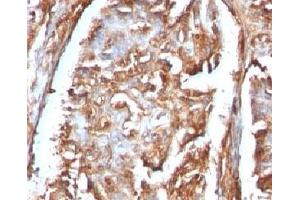 Formalin-fixed, paraffin-embedded human renal carcinoma stained with Beta-2-Microglobulin antibody.