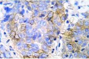 Immunohistochemistry (IHC) analyzes of JAK1 pAb in paraffin-embedded human lung adenocarcinoma tissue. (JAK1 anticorps)