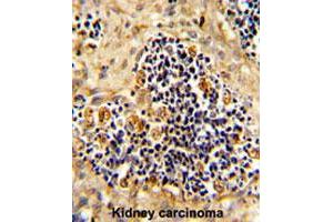 Formalin-fixed and paraffin-embedded human kidney carcionmareacted with ROR2 polyclonal antibody , which was peroxidase-conjugated to the secondary antibody, followed by AEC staining. (ROR2 anticorps  (N-Term))