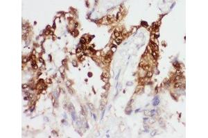 IHC-P: PGK1 antibody testing of human lung cancer tissue