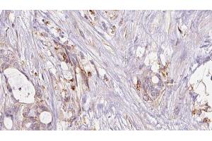 ABIN6273047 at 1/100 staining Human liver cancer tissue by IHC-P. (GSTA4 anticorps  (N-Term))