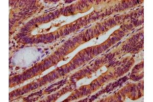 IHC image of ABIN7160684 diluted at 1:500 and staining in paraffin-embedded human colon cancer performed on a Leica BondTM system.