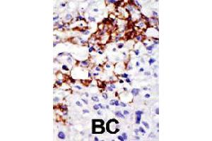 Formalin-fixed and paraffin-embedded human cancer tissue reacted with USP16 polyclonal antibody  , which was peroxidase-conjugated to the secondary antibody, followed by DAB staining . (USP16 anticorps  (AA 132-160))