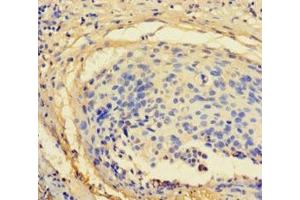 Immunohistochemistry of paraffin-embedded human cervical cancer using ABIN7176122 at dilution of 1:100 (ZNF165 anticorps  (AA 1-485))